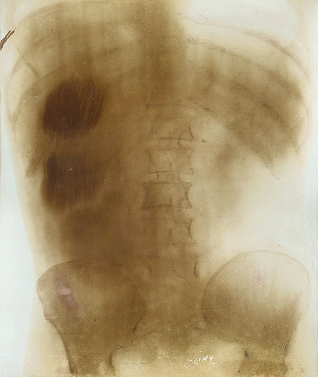 Prof. Contremoulin (attributed to) - Large X-Ray of a Torso Prof. Contremoulin (attributed to) - Large X-Ray of a Torso