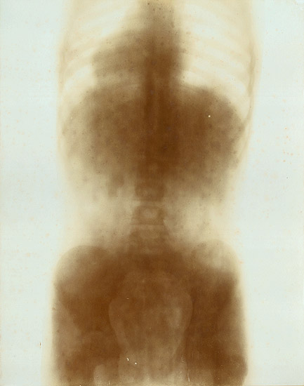 Prof. Contremoulin (attributed to) - Large X-ray of a Child's Torso Prof. Contremoulin (attributed to) - Large X-ray of a Child's Torso